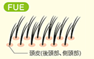 FUE