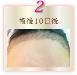 術後10日後