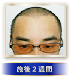 施後２週間