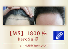 【MS】1800株