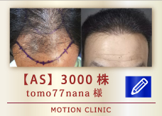 【AS】　3000株
