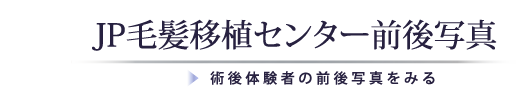 JP毛髪移植センター前後写真