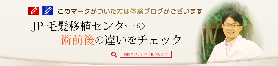 JP毛髪移植センターの術前後の違いをチェック