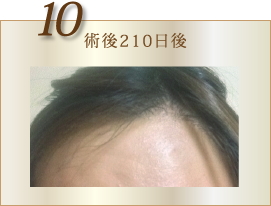 10:術後210日後