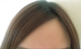 術後1０ヶ月経過後