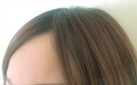 術後1０ヶ月経過後