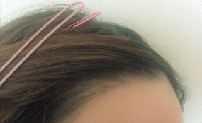 術後1０ヶ月経過後