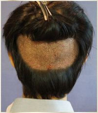 術後ウィッグなし