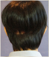 術後ウィッグなし