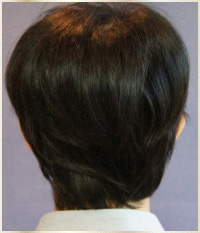 術後ウィッグ装着