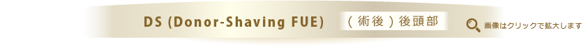 DS (Donor-Shaving FUE) (術後)後頭部