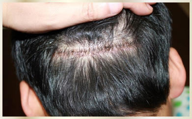 FUT 術後後頭部