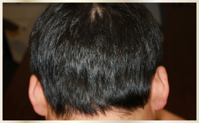 FUT 術後後頭部