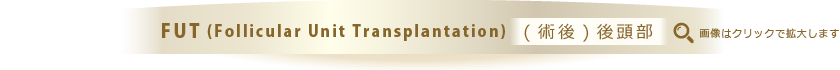 FUT (Follicular Unit Transplantation) (術後)後頭部
