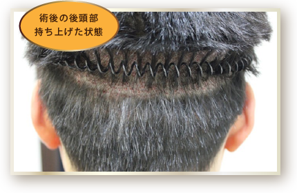 術後の後頭部持ち上げた状態