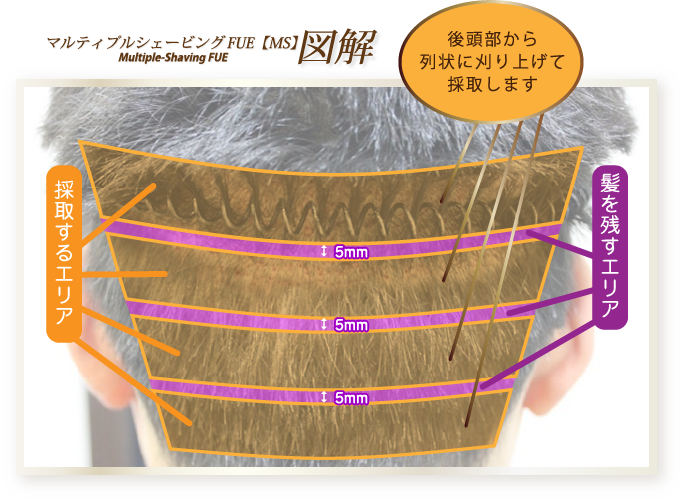 マルティプルシェービングFUE【MS】 図解